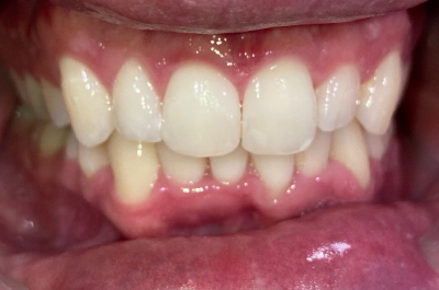 After Sparkle Dental treatment