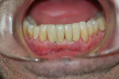 After Sparkle Dental treatment