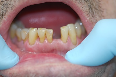 Before Sparkle Dental treatment