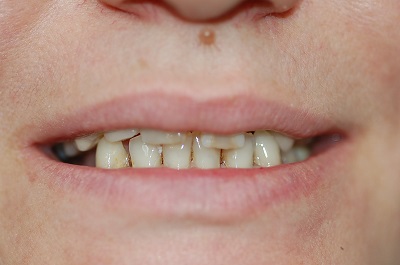 Before Sparkle Dental treatment
