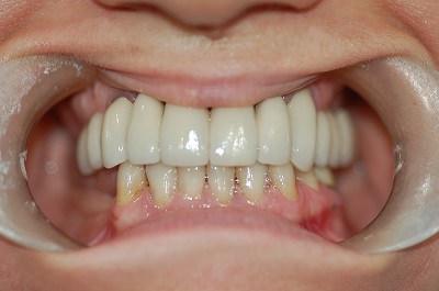 After Sparkle Dental treatment
