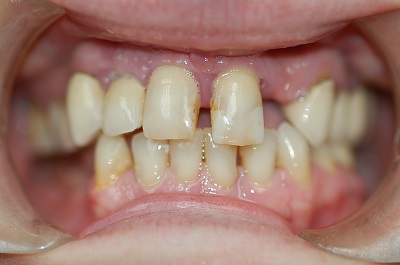 Before Sparkle Dental treatment