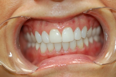 After Sparkle Dental treatment