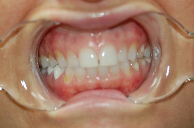 Before Sparkle Dental treatment